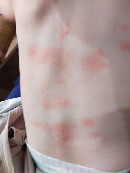 Má někdo představu, co je to za vyrážku?