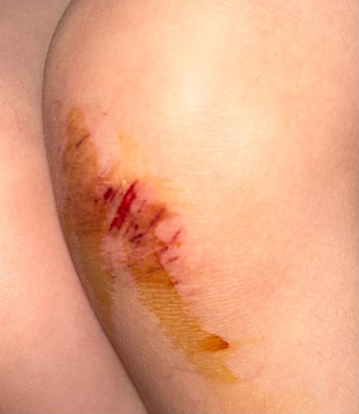 Mám jet s dcerou k lékaři po pádu?