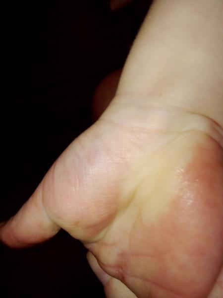 Může úraz kolene u 2,5letého dítěte být vážný?