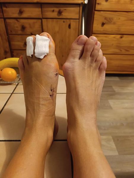 Hallux Valgus - vbočený palec - operace Mica