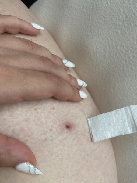 Krvavá boulička na stehně. Co by to mohlo být?