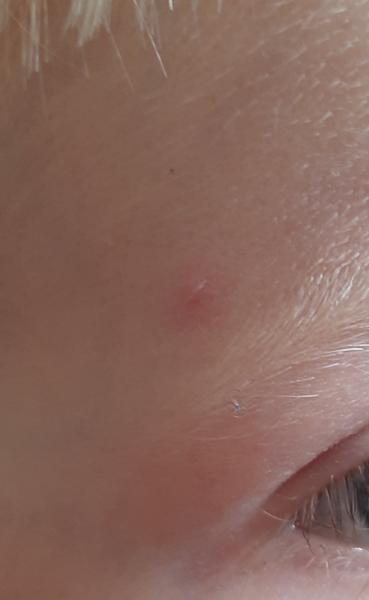 Varilrix očkování: Je možné se nakazit neštovicemi?