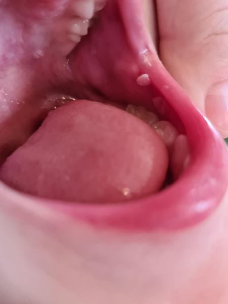 Výrůstek v ústech u dítěte. Co to může být?