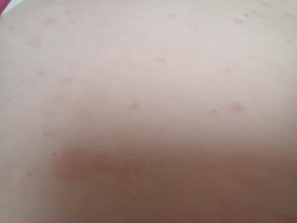 Červené fleky na těle. Může to být reakce na léky?