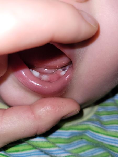 Prořezávání stoliček u dětí. Je to normální?