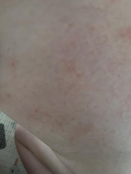 Možné příčiny vyrážky u kojence? Zkušenosti rodičů