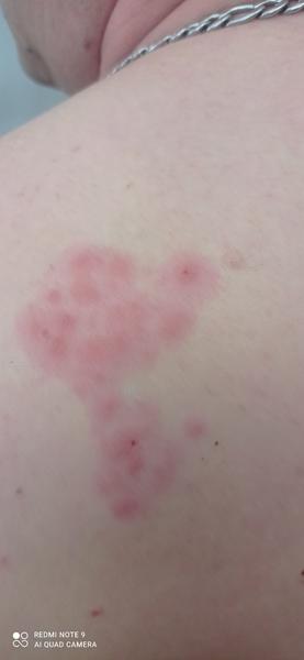 Vyrážka. Co by to mohlo být?