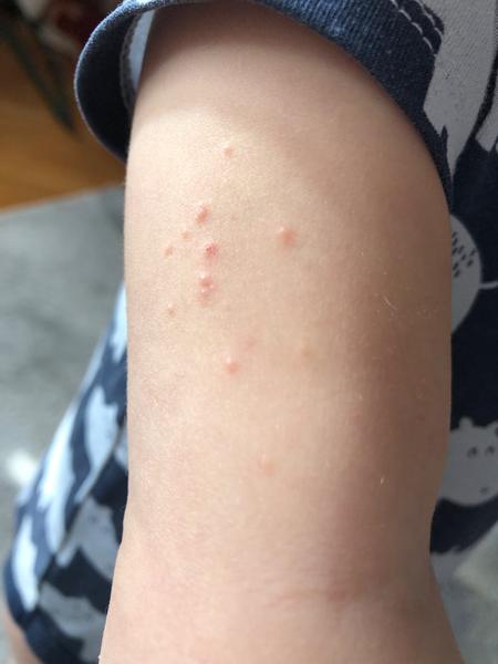 Vyrážka u dítěte. Co by to mohlo být?