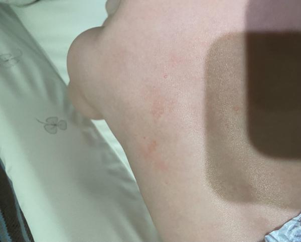 Vyrážka. Co by to mohlo být a jak řešit?