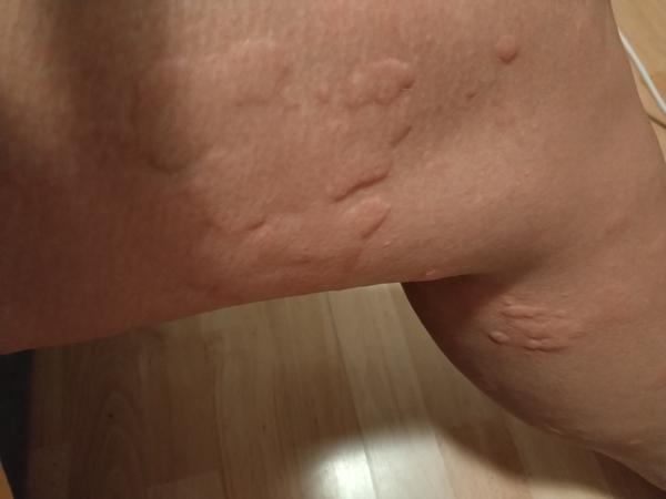 Jak řešit svědivou vyrážku na začátku těhotenství?