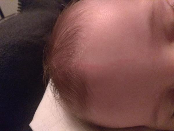 Červená čára na hlavičce kojence