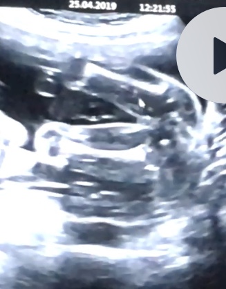 Poznáte z ultrazvuku pohlaví?