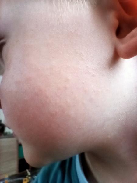 Vyrážka na obličeji a krupička po těle. Co si o tom myslíte?