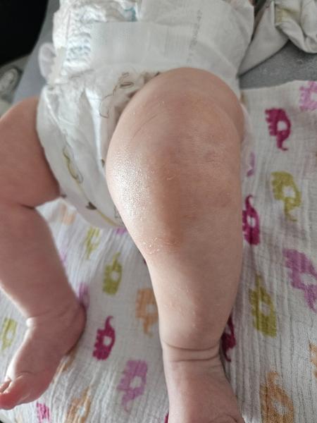 Suchá kůže, ekzém nebo kvasinka?