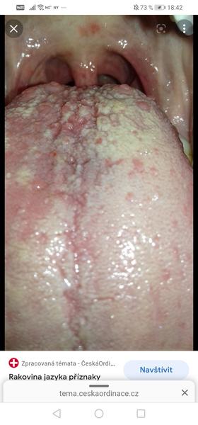 Rakovina jazyka nebo kvasinková infekce? Vyšetření je důležité!