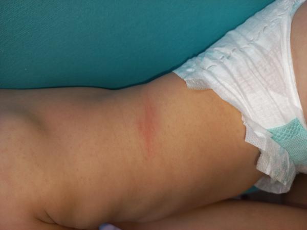 Červené malinké skvrny na zádech a bříšku. Jsou to potničky?