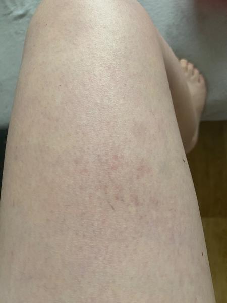 Co jsou červené skvrny na nohou?