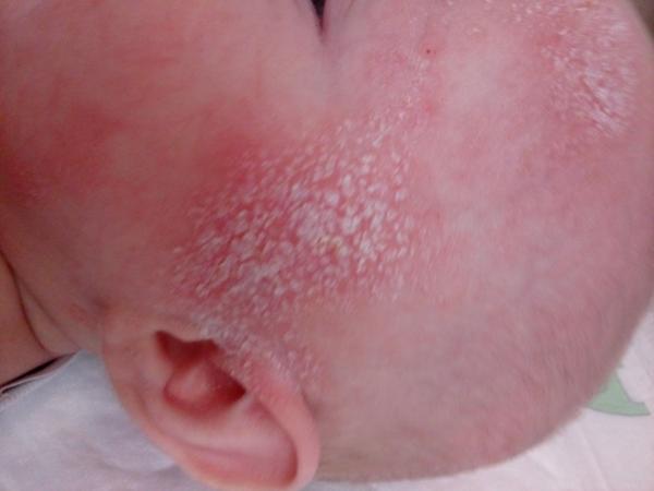 Ekzém u 4měsíčního miminka. Poradíte, prosím?