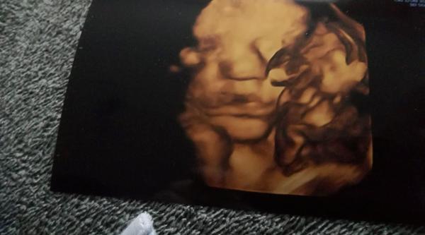 3D fotka z ultrazvuku. Kdo byl také a jaký byl výsledek po narození?