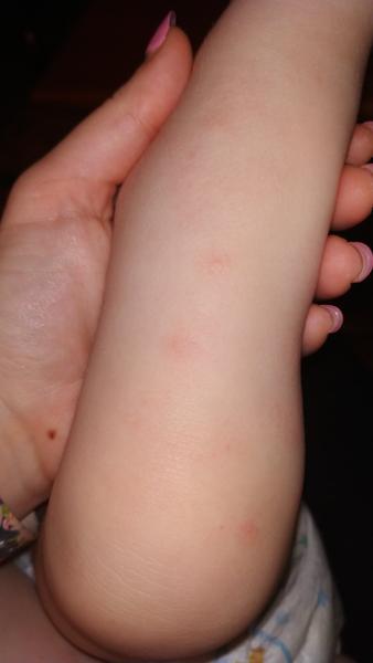 Fleky na těle dítěte. Fucidin ani Locoid nepomohly. Jak postupovat dále?