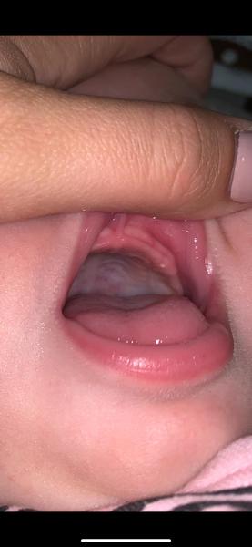 Bílá tečka na dásni. Může to být afta?