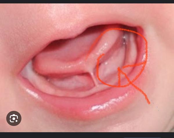 Co se nachází mezi zuby a jazýčkem bábätka?