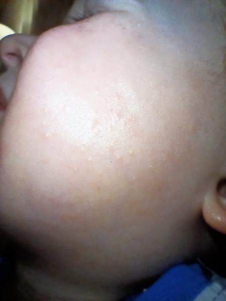 Vyrážka u dítěte. Setkal se s tím někdo?