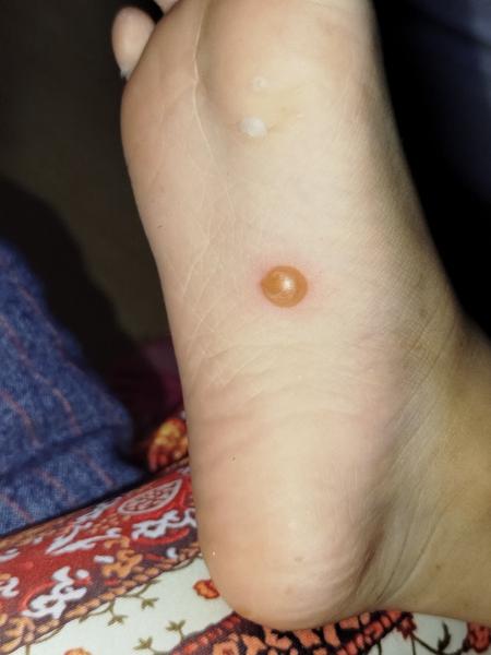 Co znamená tvrdý vřed na chodidle mé dcery?