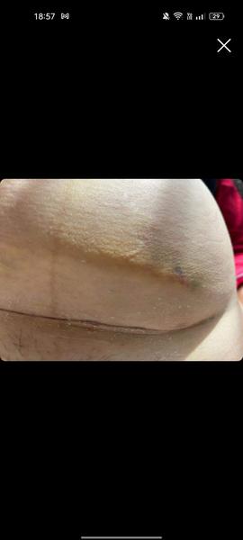 Opuch po císařském řezu. Máte podobnou zkušenost?