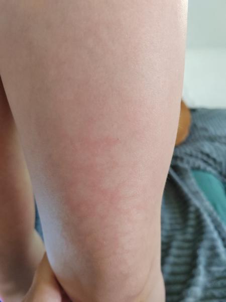 Pátá nemoc - vyrážka trvá měsíc. Jaký na to máte názor a jak pomoci, aby vyrážka zmizela?