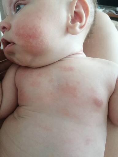 Kvasinka nebo atopický ekzém? Jak léčit?