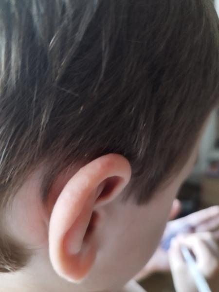 Co způsobuje pupínky na uších dětí? Zjistěte zde!