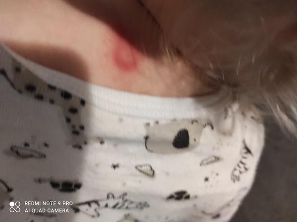 Červené fleky u dětí. Co mohou znamenat?