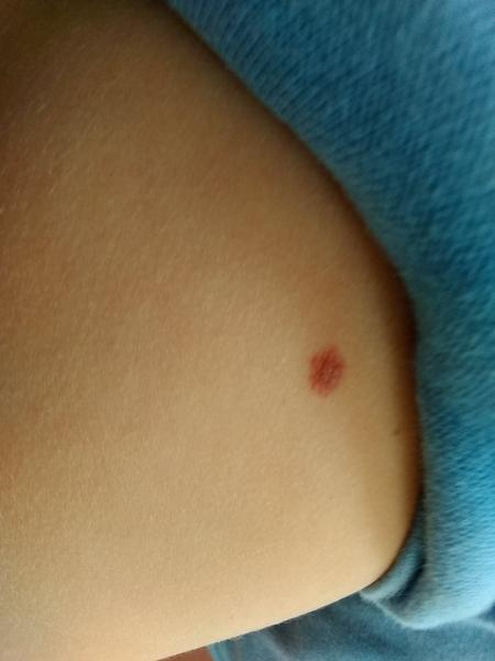 Piha. Mám urgovat kožní?