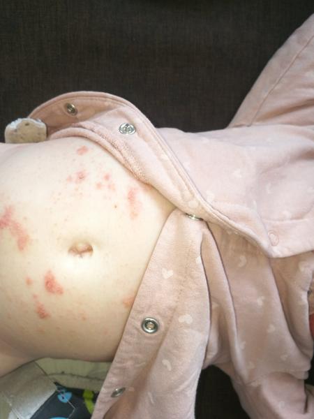 Rozsáhlý ekzém. Pomůžete, prosím?