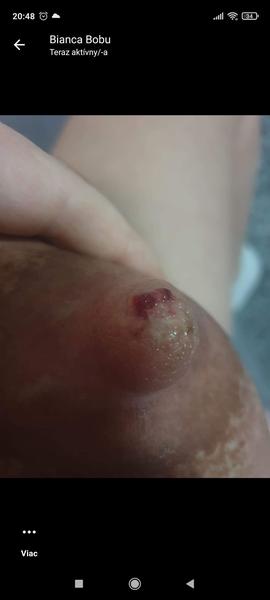 Z prsů teče krev a dítě je odmítá. Co máme dělat?