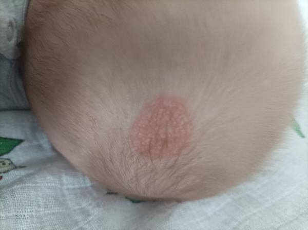 Ekzém, nebo něco jiného?