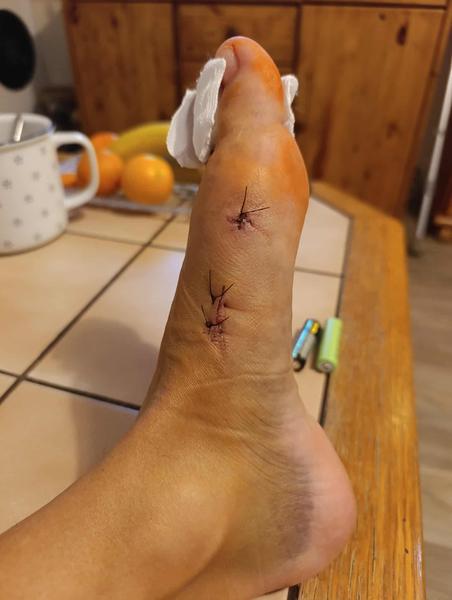 Hallux Valgus - vbočený palec - operace Mica