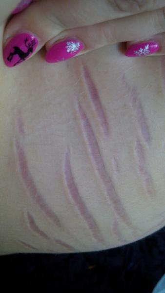 Strašné strie, jak je teď ošetřovat?