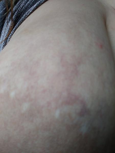 Fialové fleky na prsou. Co by to mohlo být?