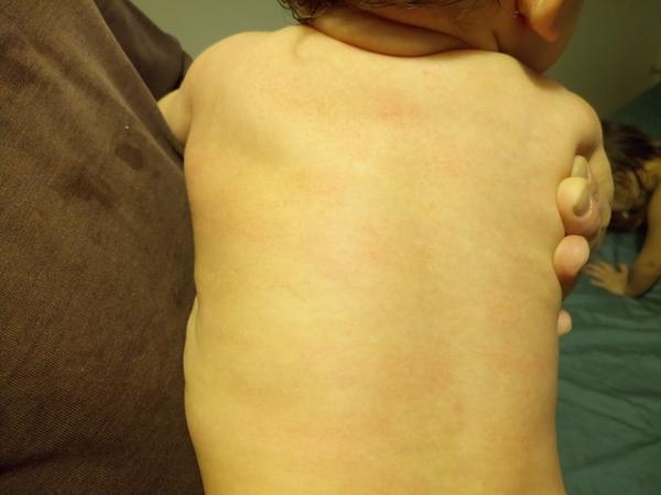 Co to může být za vyrážku u 10měsíční dcery? Je bez teplot