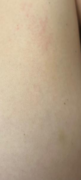 Objevily se vám modřinky na stehnech bez úrazu?