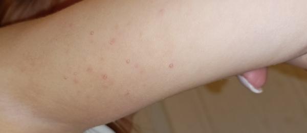 Máte podezření na molusky? Konzultace a doporučení lékařů