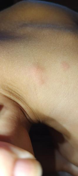 Pupínky na zádech u dítěte: Co to může znamenat?