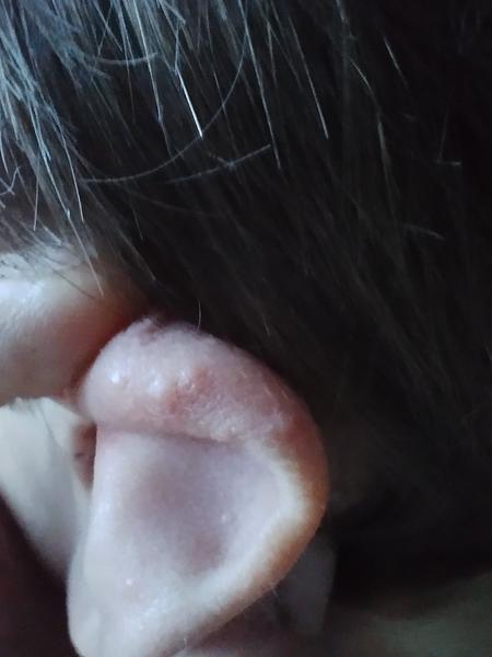 Co způsobuje pupínky na uších dětí? Zjistěte zde!