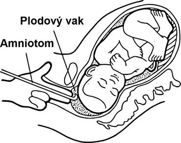 Těhotenství a plodová voda