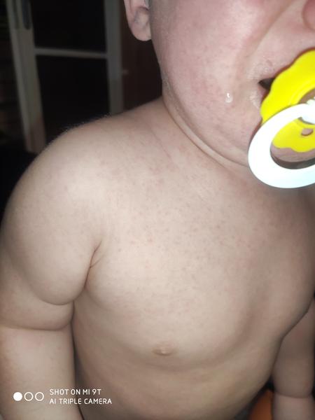 Šestá nemoc nebo spalničky - bojím se. Já měly Vaše děti vyrážky?