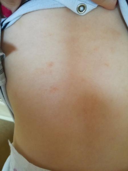 Je to ekzém ze zapocení nebo z potravin?