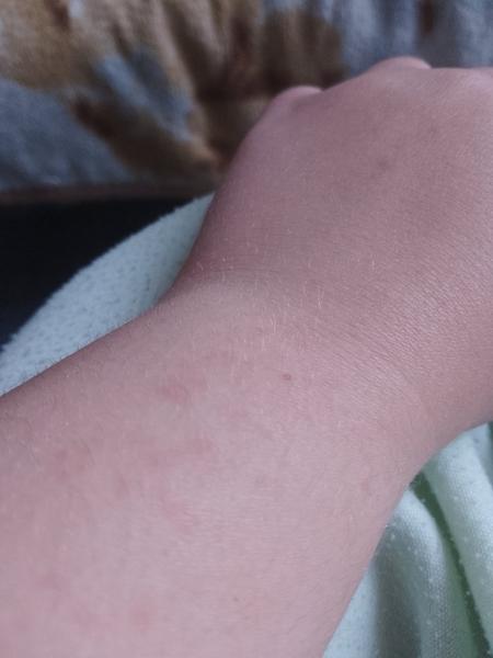 Vyrážka na ruce. Co by to mohlo být?