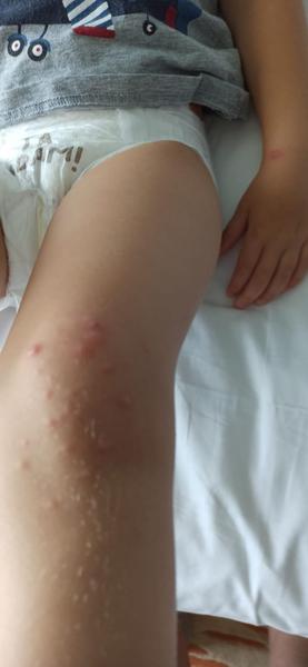 Příznaky. Můžou to být neštovice?